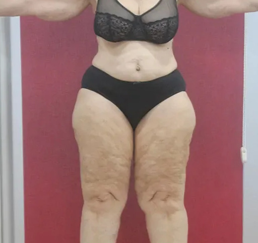 lipedema